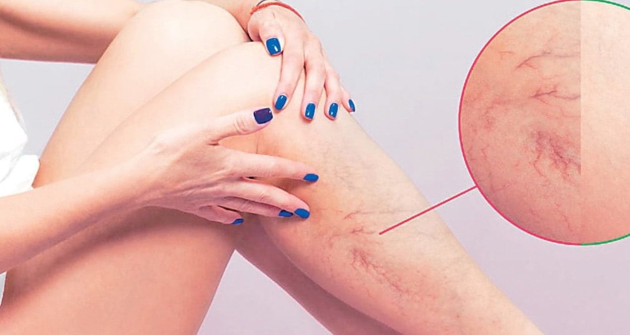 varis vucutta pihti riskini artirabilir TDi5UXEl.jpg